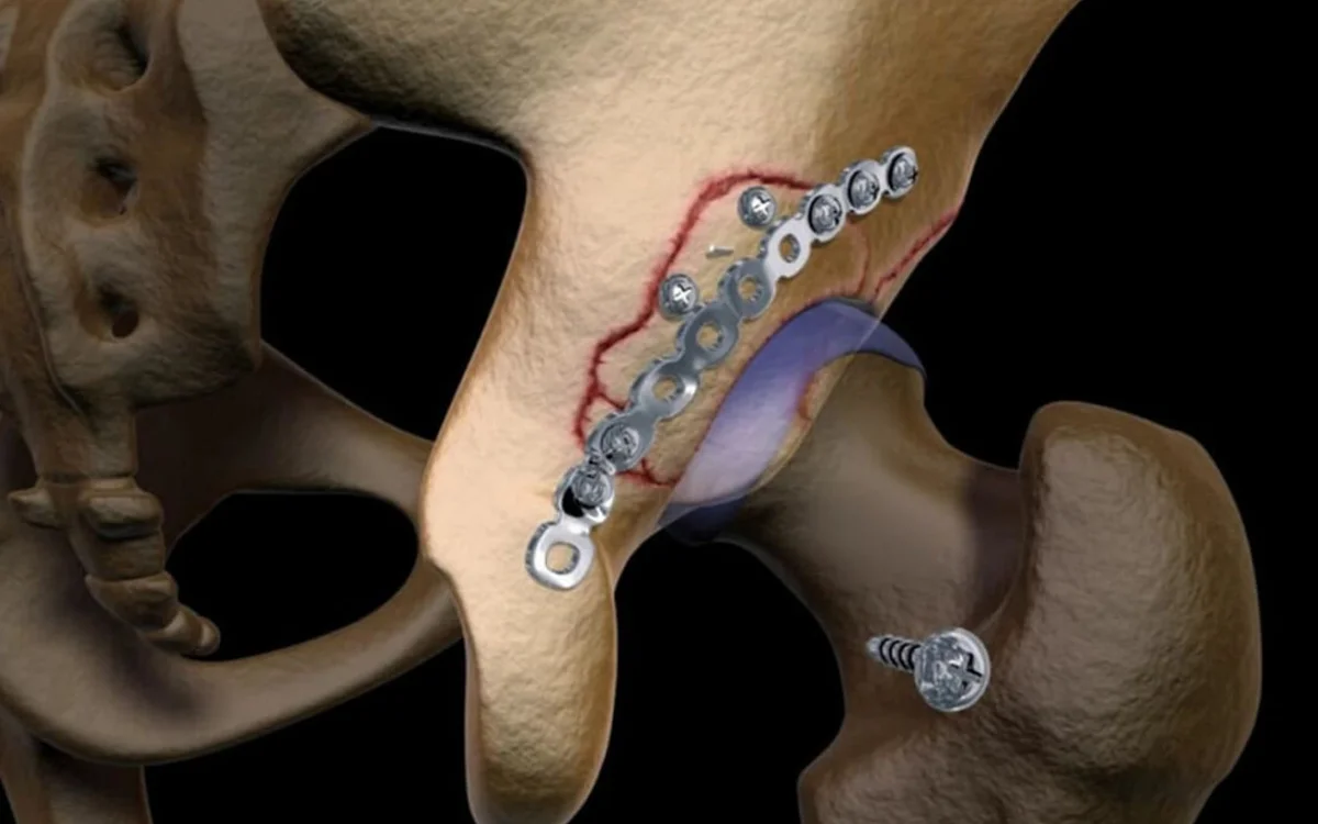 Acetabulum & Pelvic Fracture Surgery