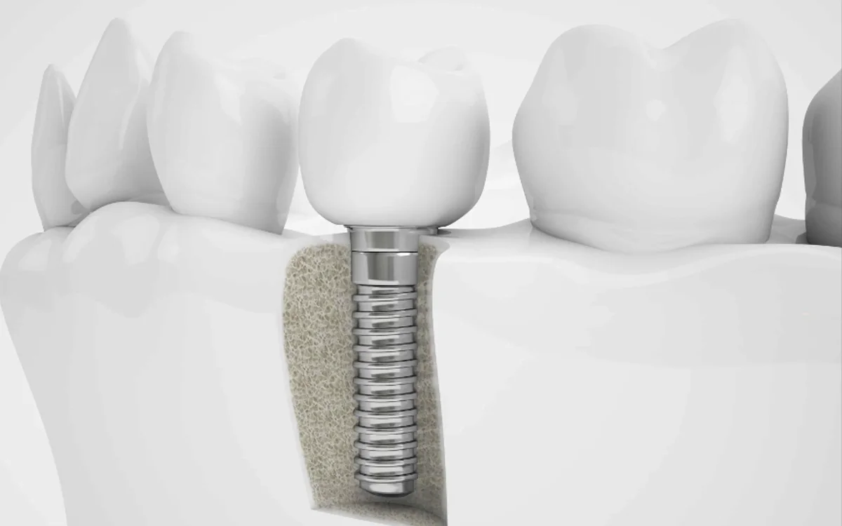 Dental Implants